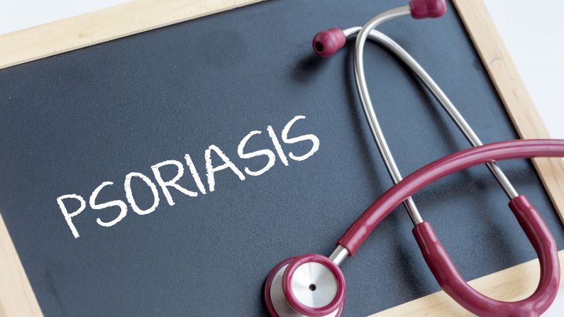 cara merawat psoriasis kulit kepala